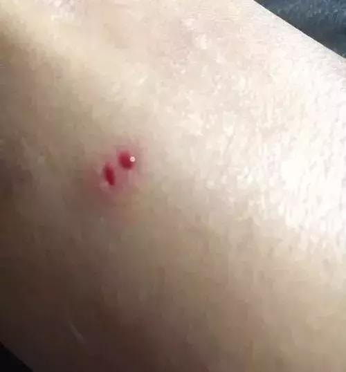 关于被蛇咬一年后还有毒吗的解析