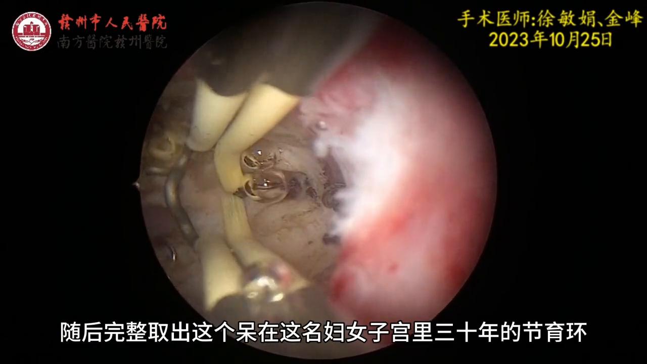 女性切除子宫视频
